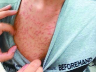 男學生胸前起紅疹子，以為是青春痘，確診為黴菌毛囊炎。圖／林書賢醫師提供