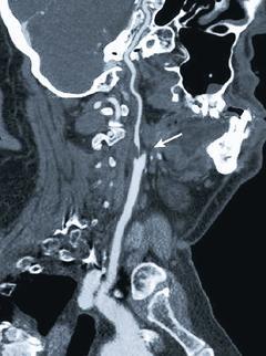 <br>從電腦斷層血管攝影觀察，頸動脈嚴重狹窄（箭頭處），頸動脈愈窄，腦中風的風險愈高。</br>
圖／報系資料照