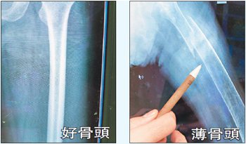 正常的大腿骨在Ｘ光畫面中可以看到骨頭兩側都有相當明顯的厚度。（左圖）
85歲游阿嬤不慎骨折，醫師發現阿嬤骨頭已薄如蛋殼。（右圖）
記者凌筠婷／攝影