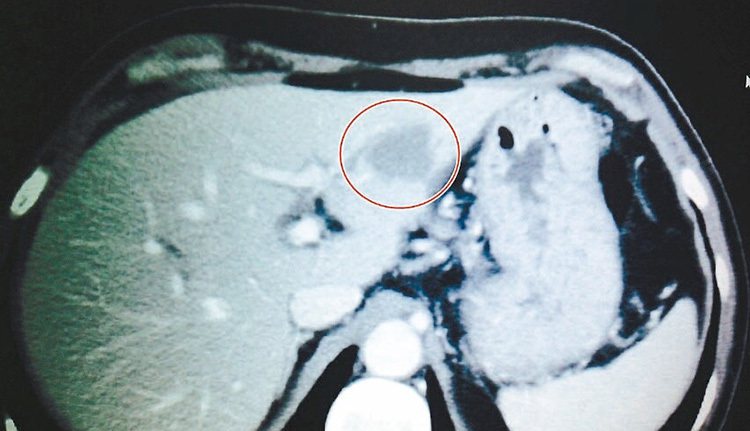 67歲吳姓婦人與2個女兒都發現罹患肝癌，大女兒X光片明顯可見肝臟有約2.5公分腫瘤。