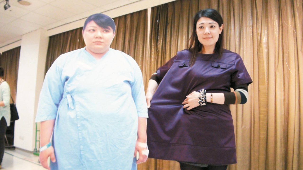 蘇雅婷接受腹腔鏡微創胃縮小手術，手術後一年半甩肉54公斤，穿上以前的衣服如同套布袋。