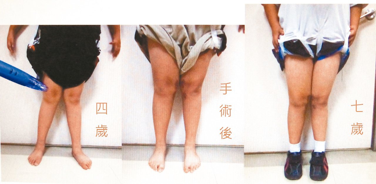 這名男童因X型腿，走路常跌倒，經就診手術後獲改善。