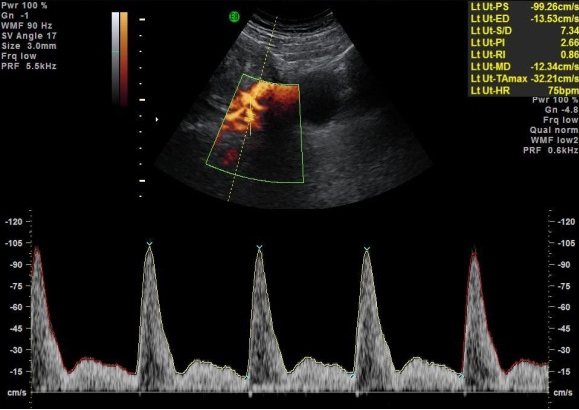 超音波下子癲前症高危險群子宮動脈血流量測。 圖／蘇怡寧醫師提供