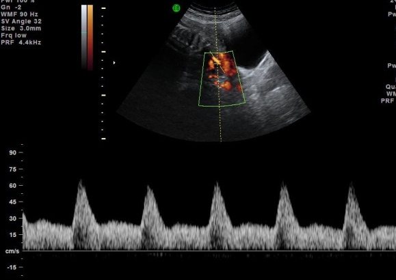 超音波下正常妊娠子宮動脈血流量測。<br />圖／蘇怡寧醫師提供