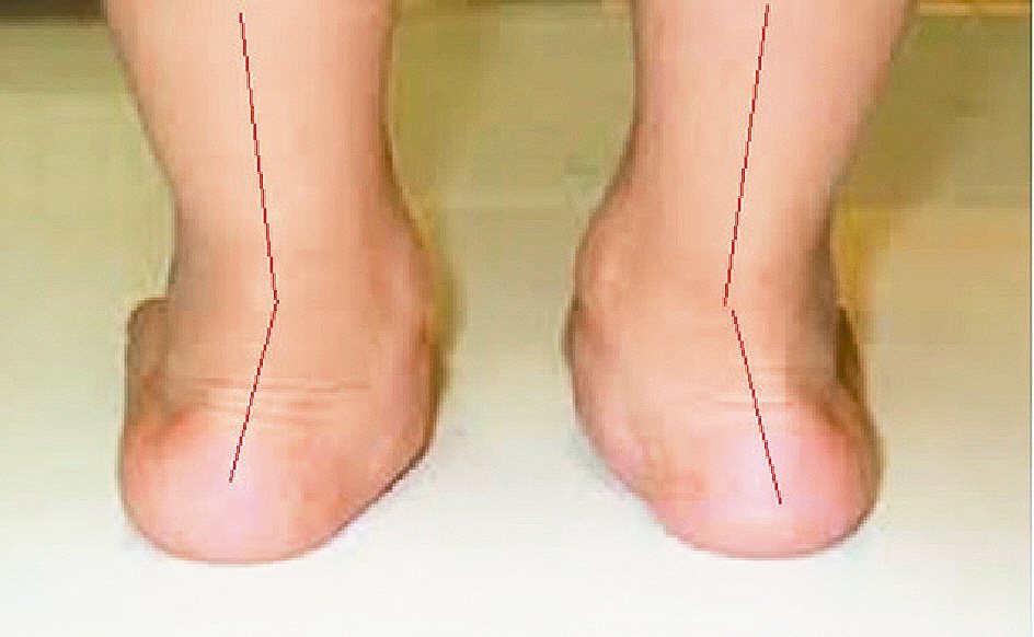 扁平足，外觀即可辨識（圖），赤腳走路更可看出其特有的內傾(pronation)步態；以特定角度X光片來看，呈現某些負重腳骨間的相關角度有差異，或關節骨頭的一些變化，診斷並不困難。