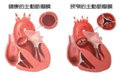 健康的主動脈瓣膜、狹窄的主動脈瓣膜