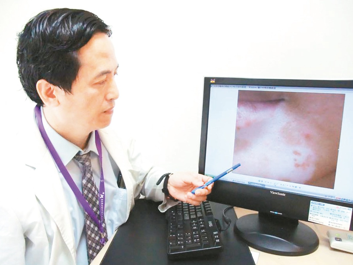 外科主任吳文宏指出，白斑症是黑色素含量異常導致，多發生在10~30歲間的男女，可透過照光、藥物及手術治療。