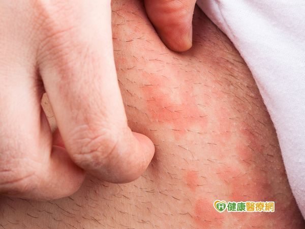 異位性皮膚炎許多成年人也會發作到全身
