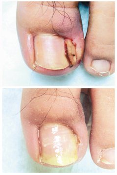醫師提醒民眾，剪指甲別剪太過。圖上為治療前，圖下為治療後。<br />書田診所／提供