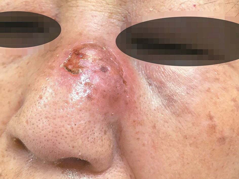 一名婦人因鼻子紅腫擴散到眼眶周圍，到新竹國泰綜合醫院就診，診斷為罹患鼻腔型淋巴腺外NK/T細胞淋巴癌。