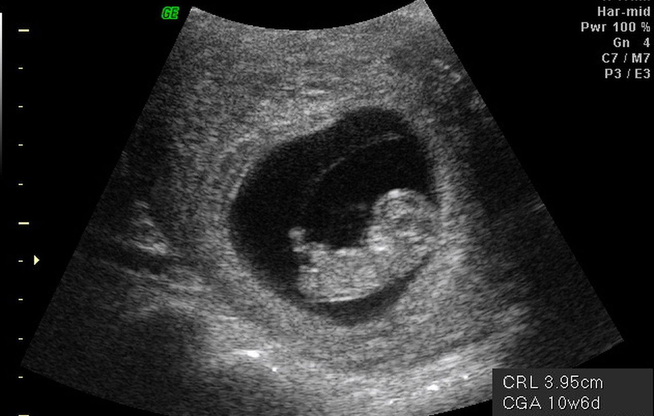 婦女懷孕前三個月，胚胎歷經層層考驗才能發展成形，圖為懷孕十二周的胚胎超影波影像。
