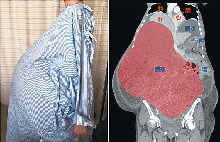 劉女士腫瘤不斷增大，已壓迫到周邊器官（右圖，北醫提供）。