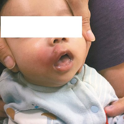 4個月大張姓男嬰嘴角遭蚊子叮咬，不僅紅腫，還感染造成蜂窩性組織炎。<br />圖／童綜合醫院提供