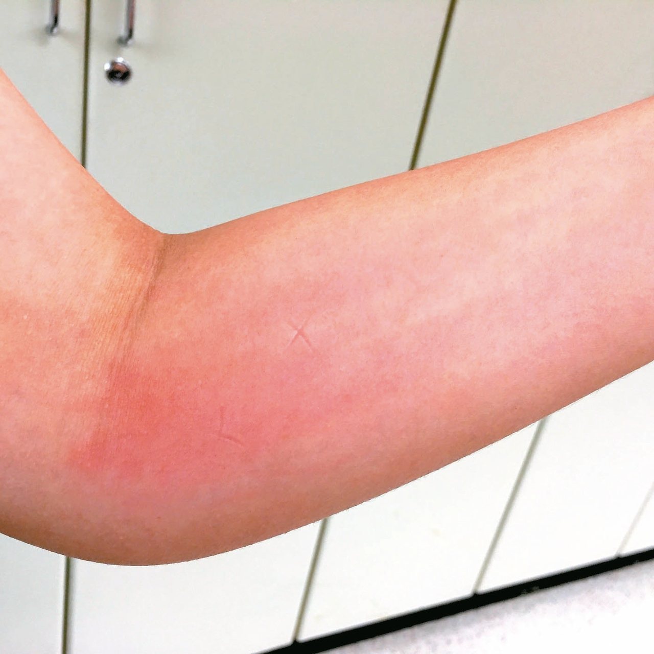 遭蚊蟲叮咬常使皮膚紅腫癢，醫師指出，常見的指甲壓痕或用原子筆畫圈，都是錯誤止癢方式。