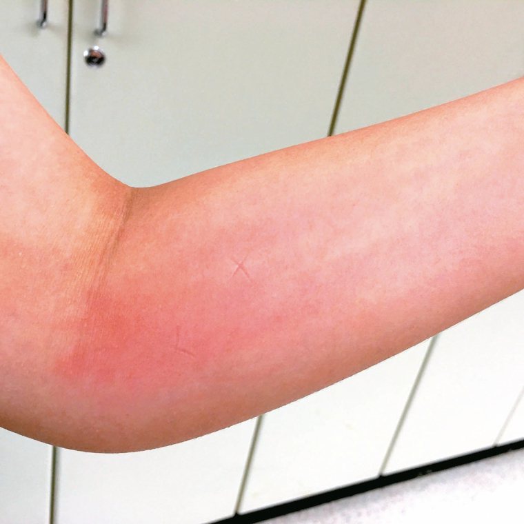 遭蚊蟲叮咬常使皮膚紅腫癢，醫師指出，常見的指甲壓痕或用原子筆畫圈，都是錯誤止癢方...