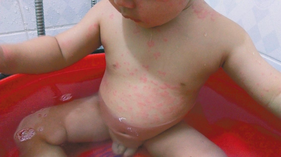 1歲5個月的陳姓男童吃了月亮蝦餅後，得了急性蕁麻疹，身上陸續長出紅疹。<br />圖／童綜合醫院提供