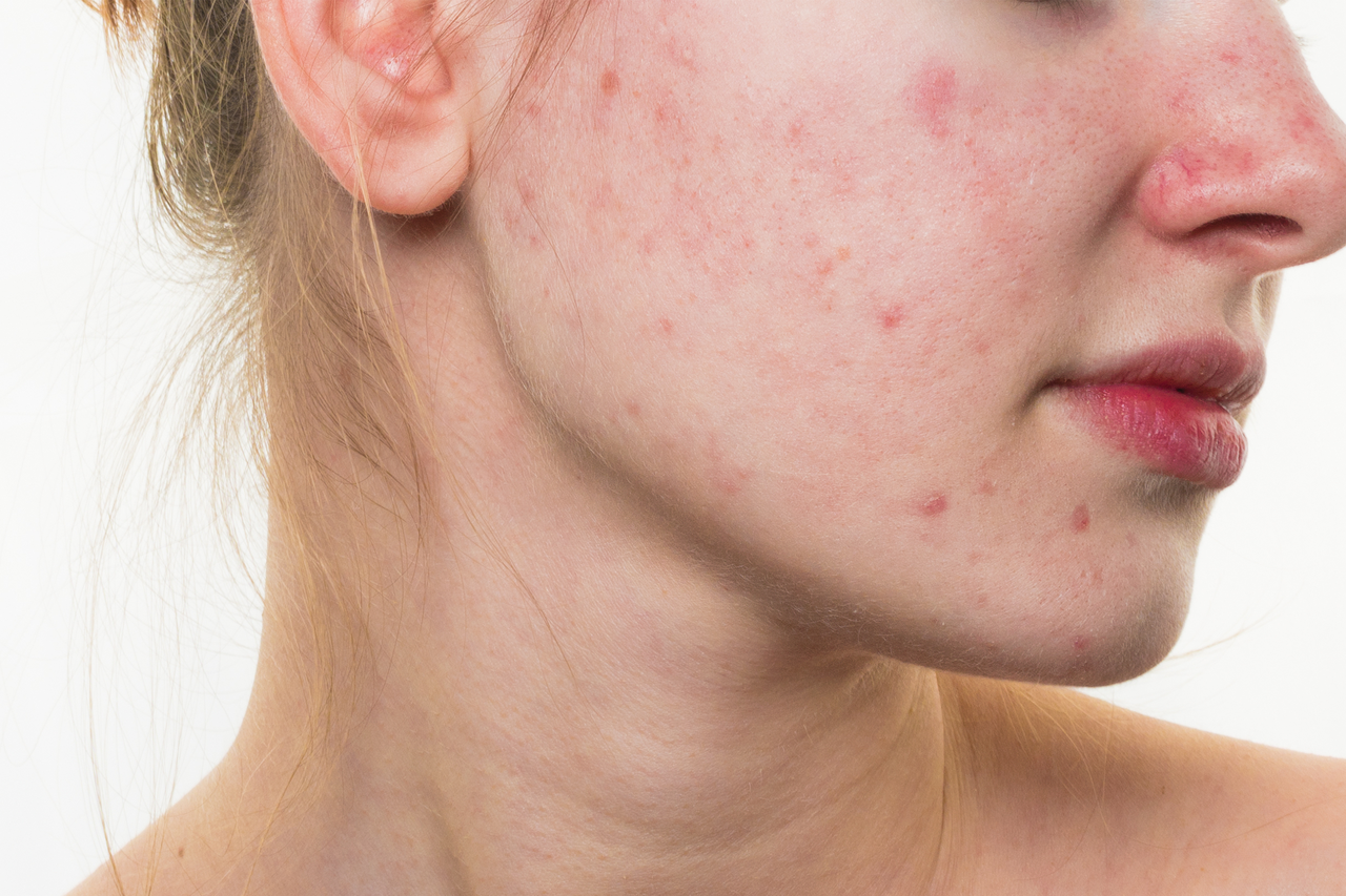 玫瑰斑為臉部皮膚慢性發炎，大部分原因為受到高溫、日曬的刺激，或是運動後皮膚血流量增加，以致血管擴張，引發皮膚紅斑。圖／shutterstock