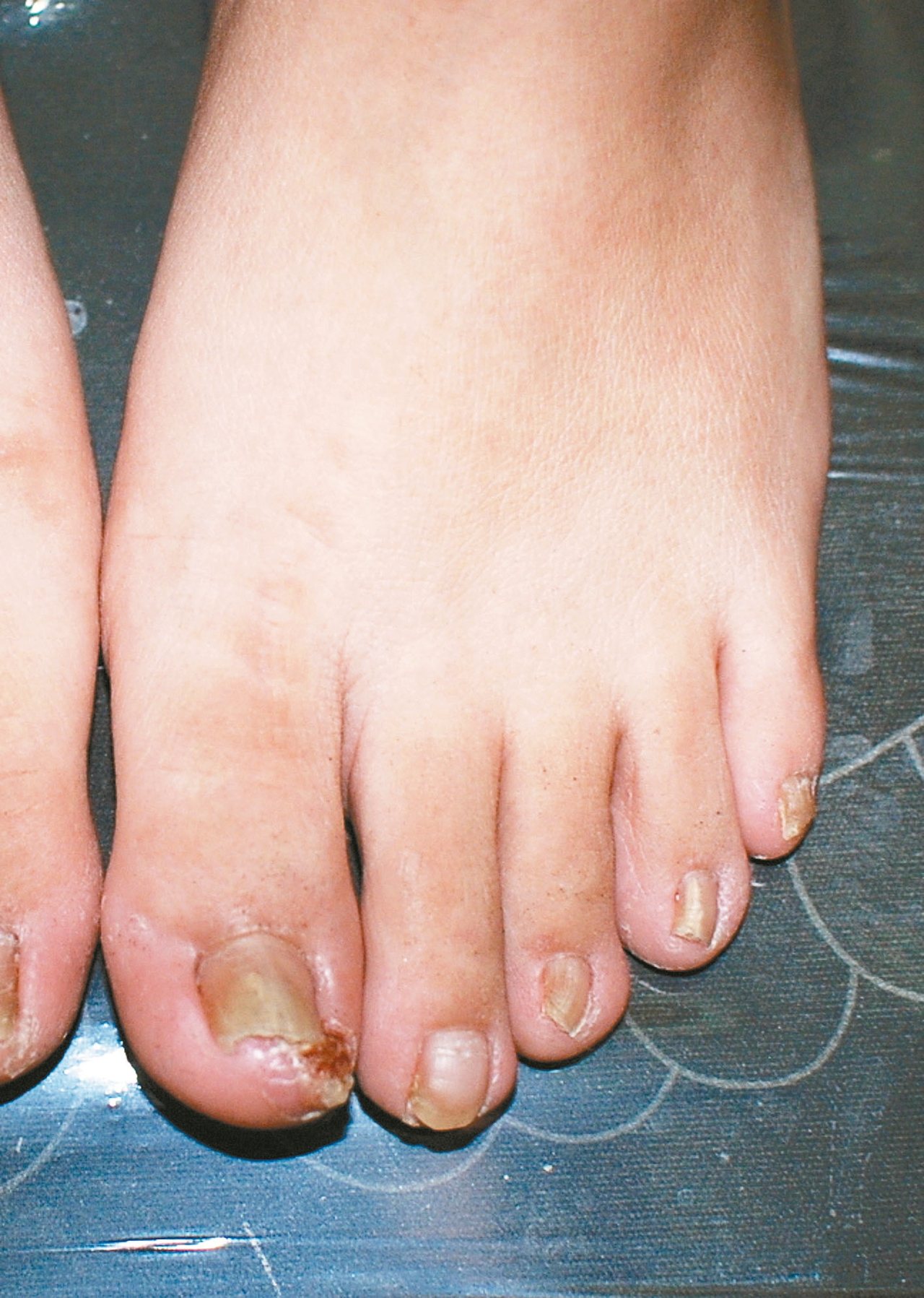 腳趾指因為灰指甲的關係有增厚變形的情況，也因為擠壓的關係，指甲往兩邊刺入周邊組織，而造成明顯的紅腫發炎感染及肉芽組織增生，這就是所謂的甲溝炎（圖）的表現。
