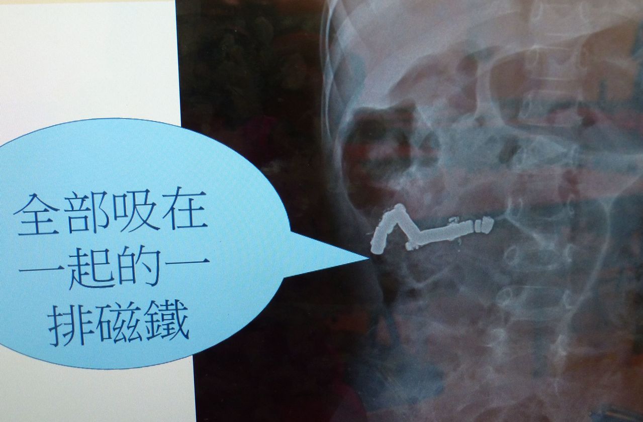 4歲王姓男童誤吞26顆針灸用圓盤狀磁石卡在小腸內，造成腸扭轉、腸阻塞，差點壞死。圖片／醫師陳德慶提供