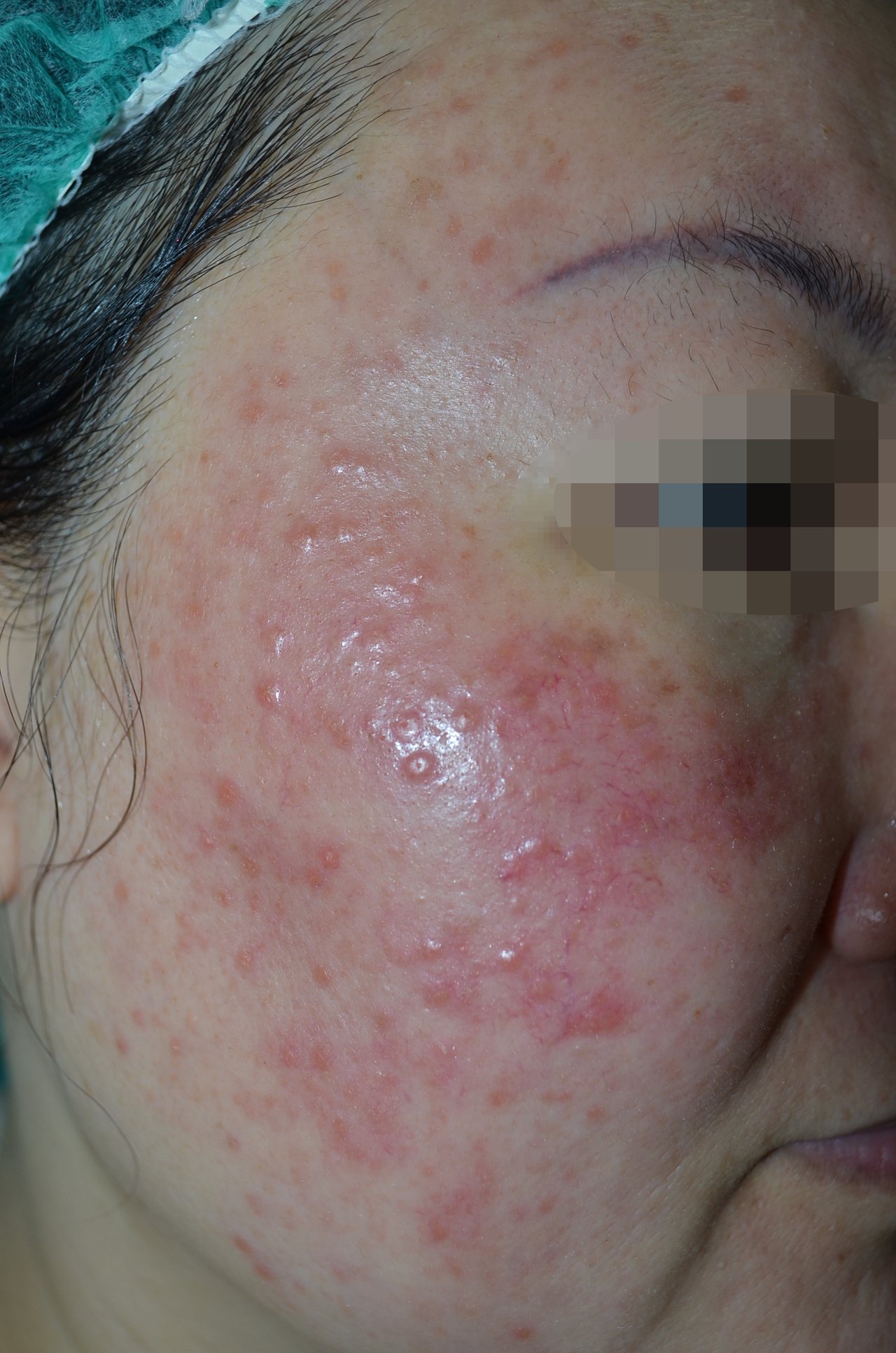 治療前臉頰可見明顯血絲及丘疹。圖／新竹馬偕醫院提供