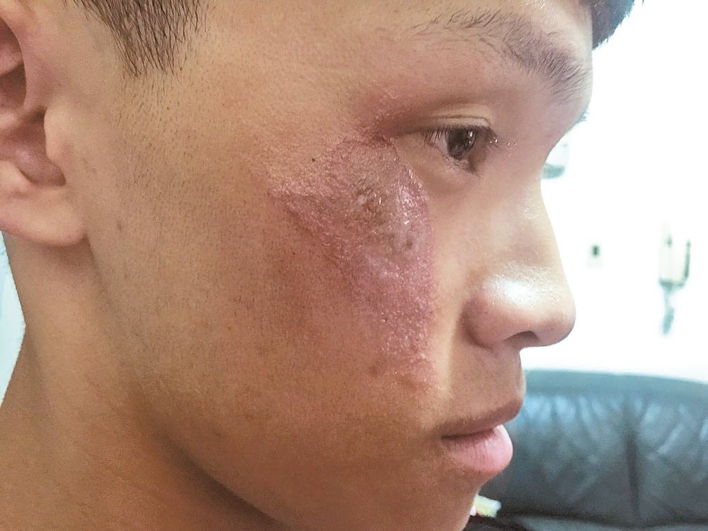3年級的男大學生，因拍打棲息在臉部的隱翅蟲，造成臉部潰爛，讓他非常沮喪。