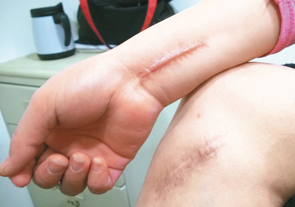 吳姓女子腳疤痕治療成效佳，目前手部持續治療中。