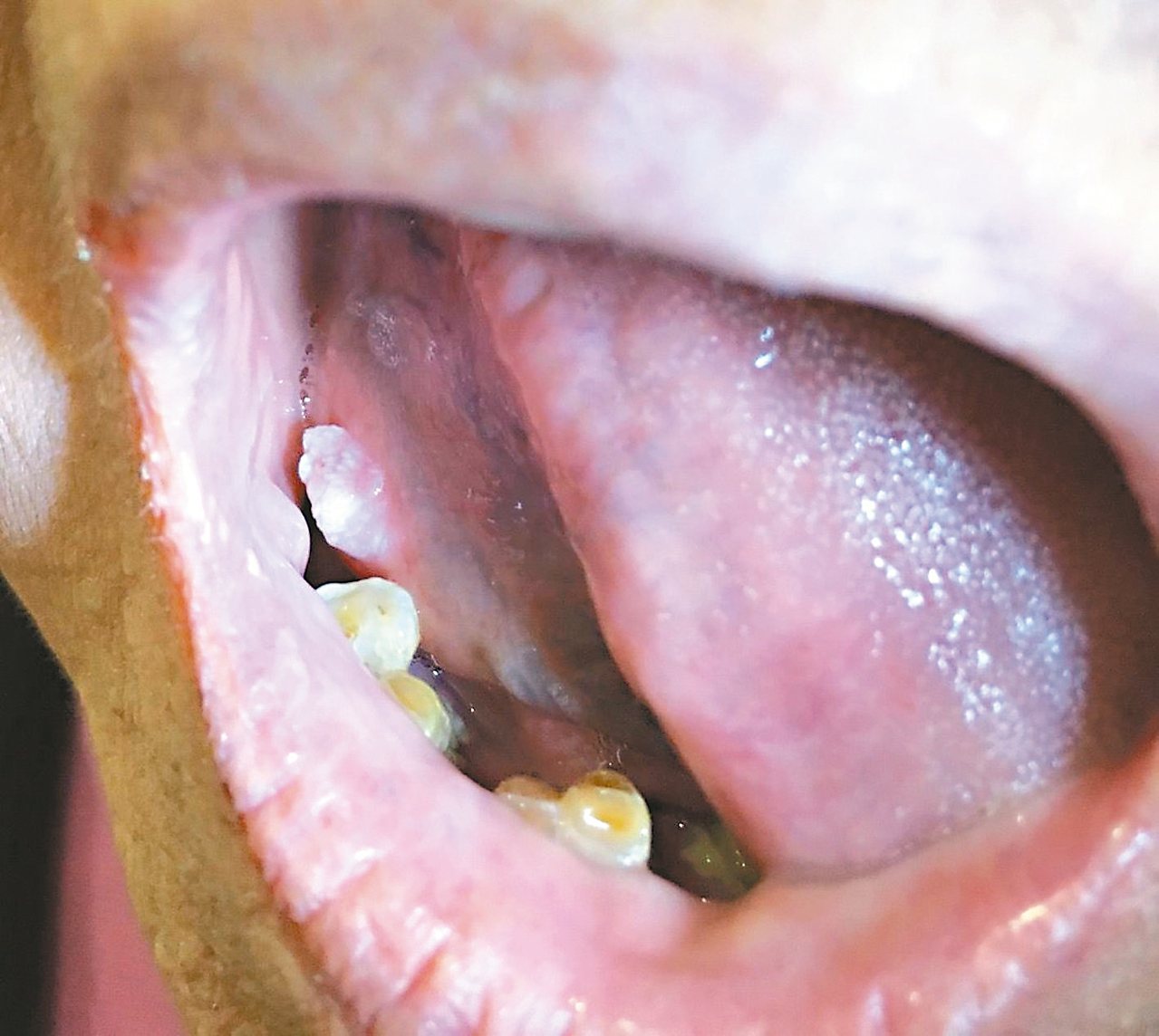 舌根處凸起的腫瘤。<br />圖／彭賢禮皮膚科診所提供
