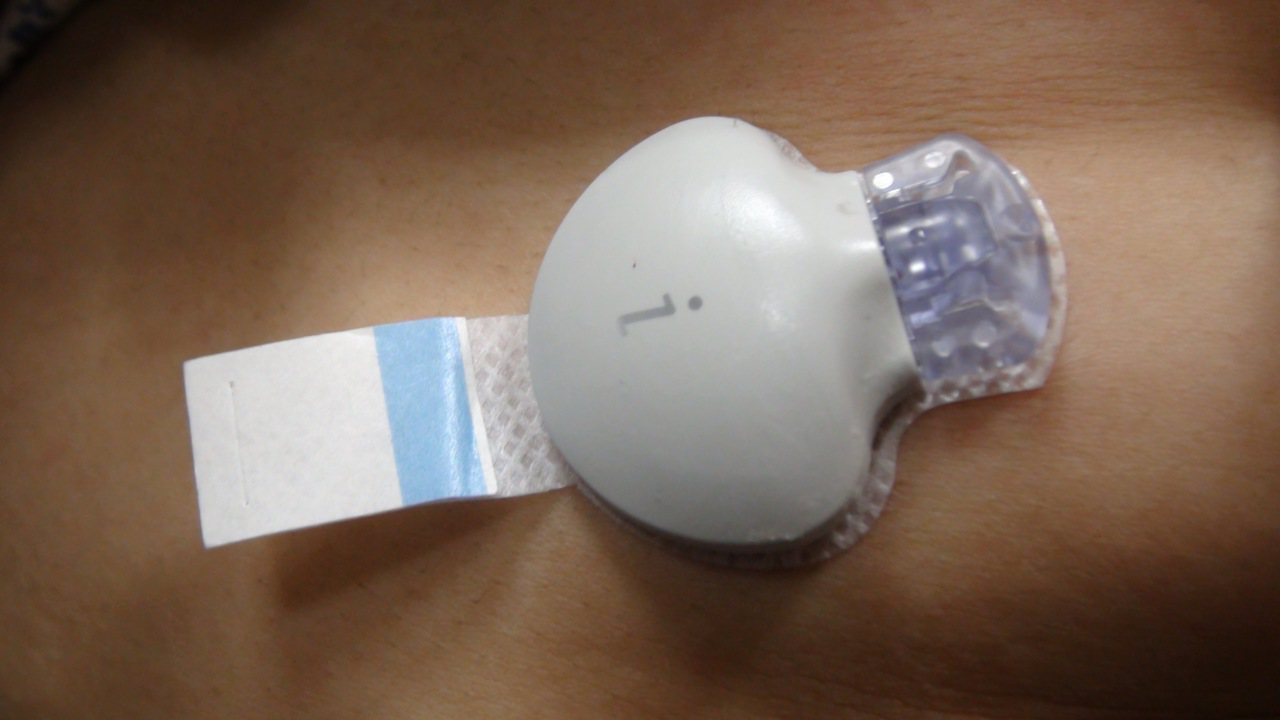 血糖紀錄器安裝於肚皮或手臂都可以。記者郭宣彣／攝影