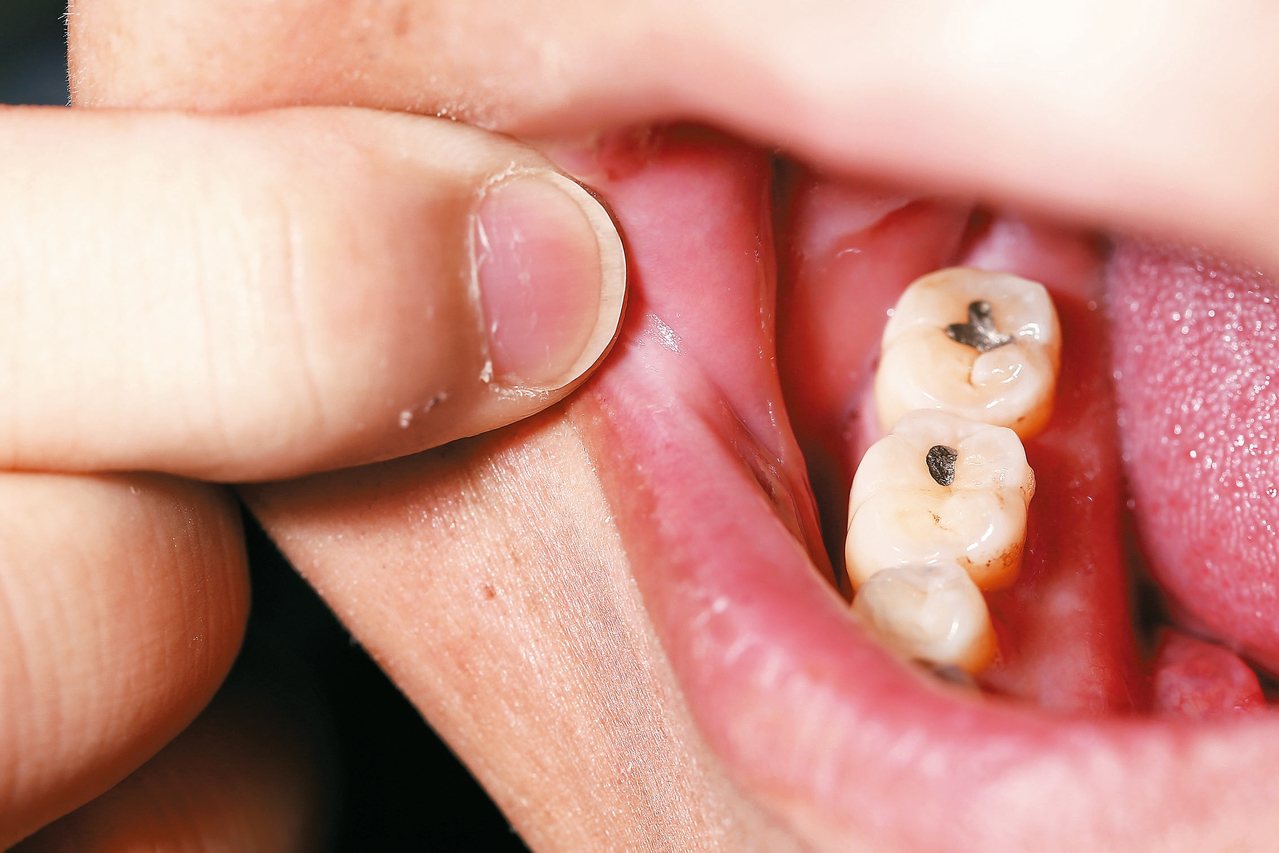 人類使用銀粉補牙歷史已久。