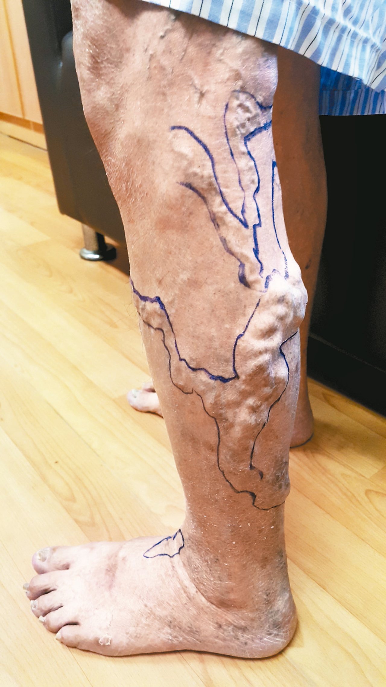 雙腿如有痠硬脹麻腫痛等症狀，或有細小血管像蚯蚓浮凸，都應該盡速求診。