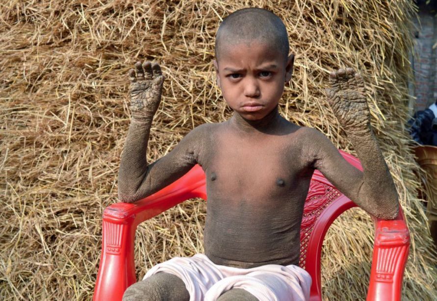 孟加拉一名8歲男童哈珊身體長滿癬，許多醫生對他的病情束手無策。圖擷自The Si...