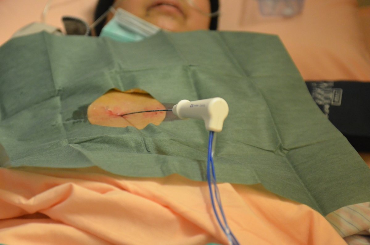 「多針電極射頻燒灼手術」幫助患者消除肝腫瘤。台北慈濟醫院／提供