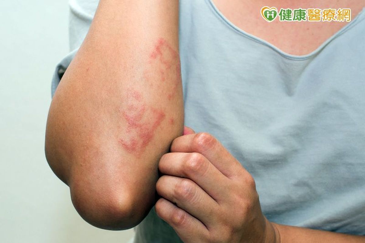 乾癬常見表徵是肌膚會出現塊狀的紅斑，以及銀白色皮屑。