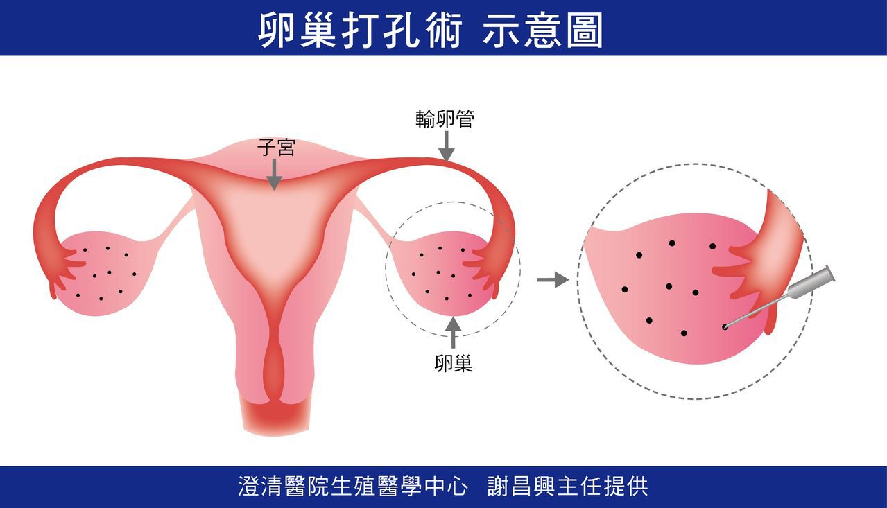 醫師謝昌興說明，卵巢打細孔，如同為卵子打開多個窗口，讓卵巢正常排卵，順利進入輸卵管受精。圖／醫師謝昌興提供