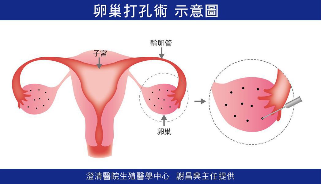 醫師謝昌興說明，卵巢打細孔，如同為卵子打開多個窗口，讓卵巢正常排卵，順利進入輸卵...