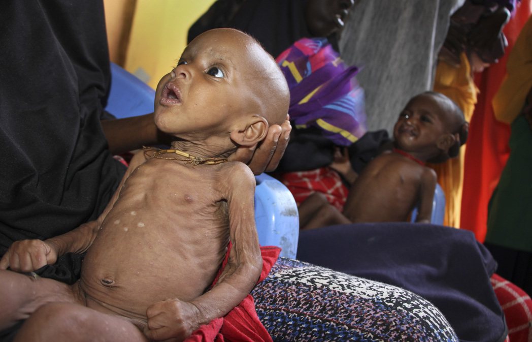 索馬利亞面臨糧食短缺困境，孩童普遍營養不良。（美聯社）