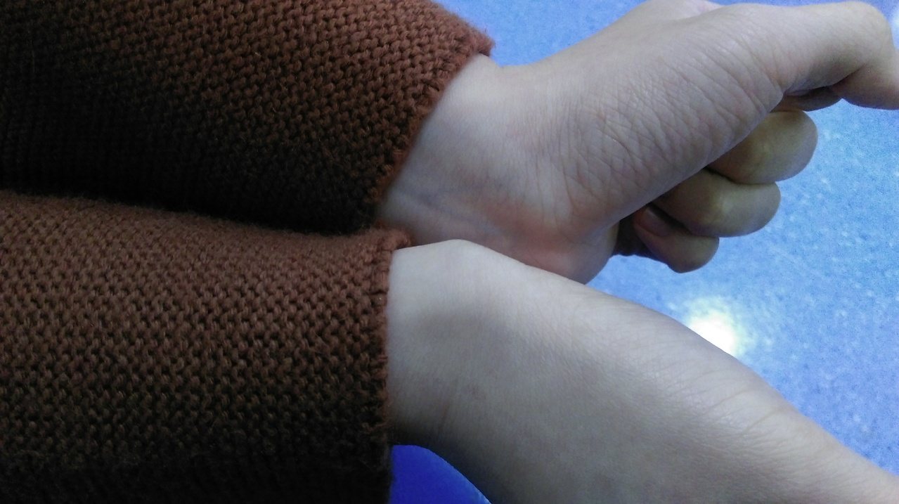 陳姓女子因手腕長期使用滑鼠，右手手腕處突出一個瘤狀物，即「腱鞘囊腫」。圖／童綜合醫院提供