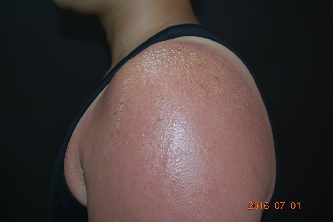 艷陽高照時如果沒有適當的防曬，常常會造成皮膚曬傷，讓皮膚輕則出現泛紅、灼熱，重則出現刺痛、水泡，甚至引起脫水等全身性的症狀。圖／奇美醫院提供