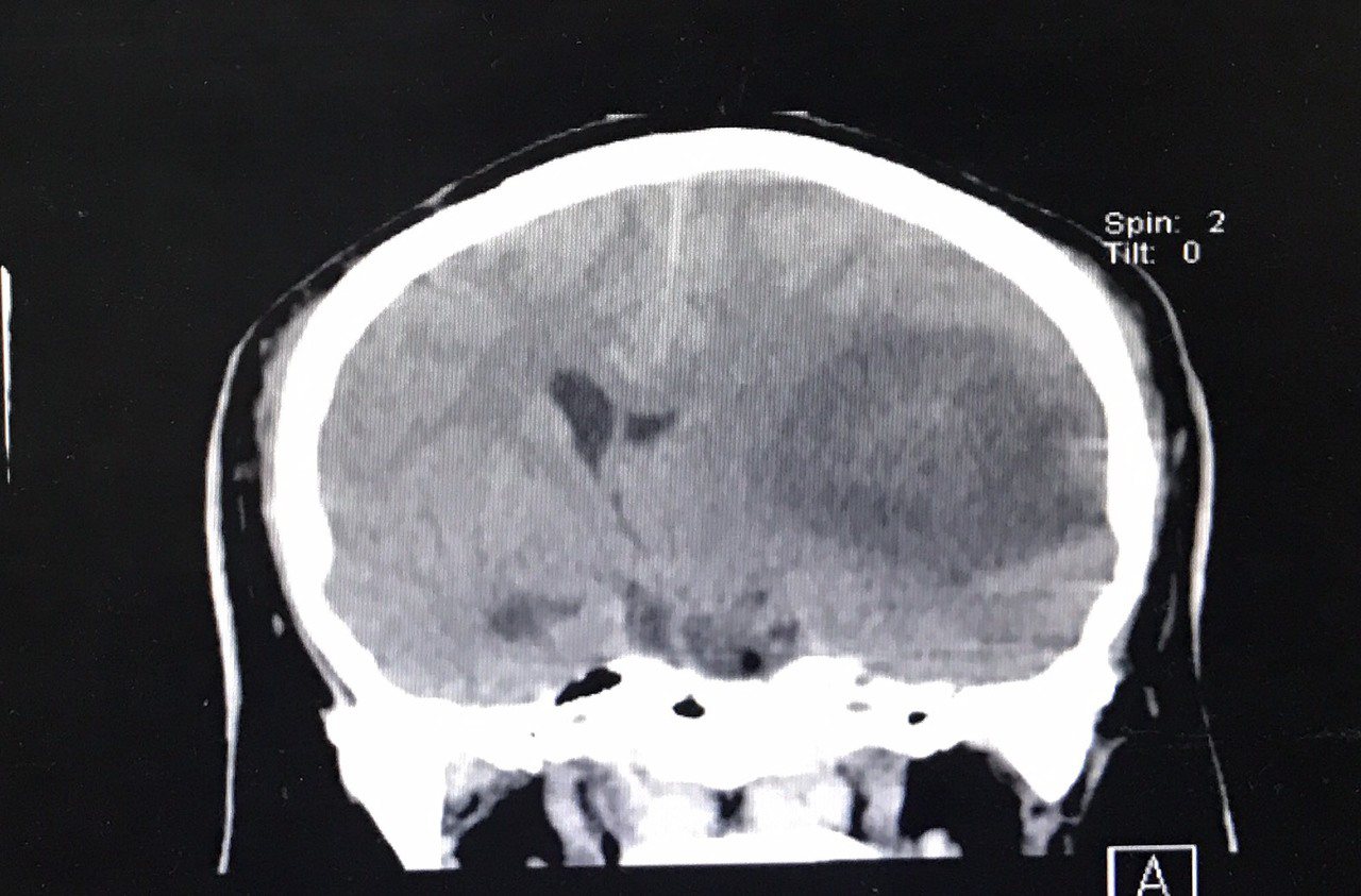 斷層掃描顯示林姓男子的左腦有大片黑色血塊，明顯腫脹，擠壓到右腦。圖／秀傳提供