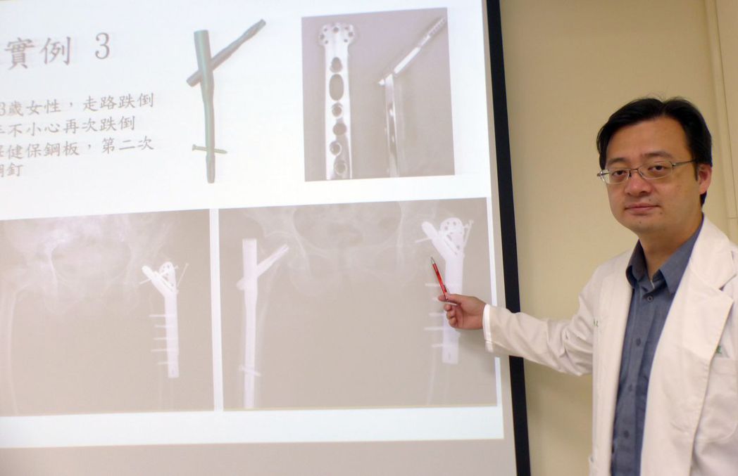 醫師羅宏愷說明，83歲老婦人去年以健保鋼板、螺絲互鎖方式固定骨折（右側），出現螺...