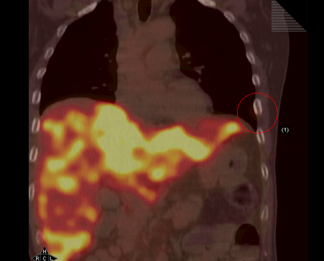 該名62歲男子因背痛問題求診，最後卻發現大腸癌，肝臟內的腫瘤在正子造影影像上呈現金黃火焰形狀。圖／黃冠誠醫師提供