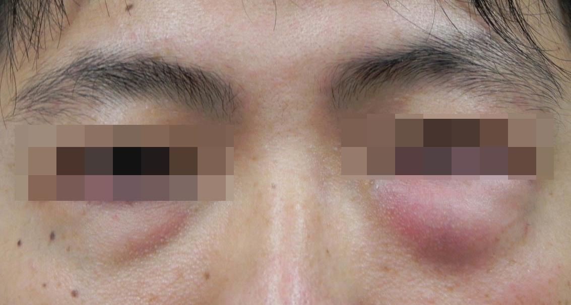 個案男子擤鼻涕用力過度，擤裂眼眶骨頭，導致空氣從裂骨灌進眼袋皮下。