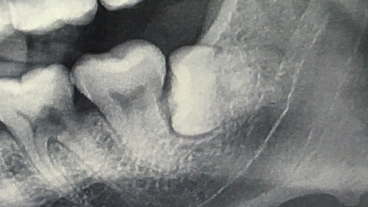 智齒（右）、牙根已橫躺狀態，容易擠壓前排牙齒，甚至頂住臼齒清潔不易，造成蛀牙。記者陳妍霖／翻攝
