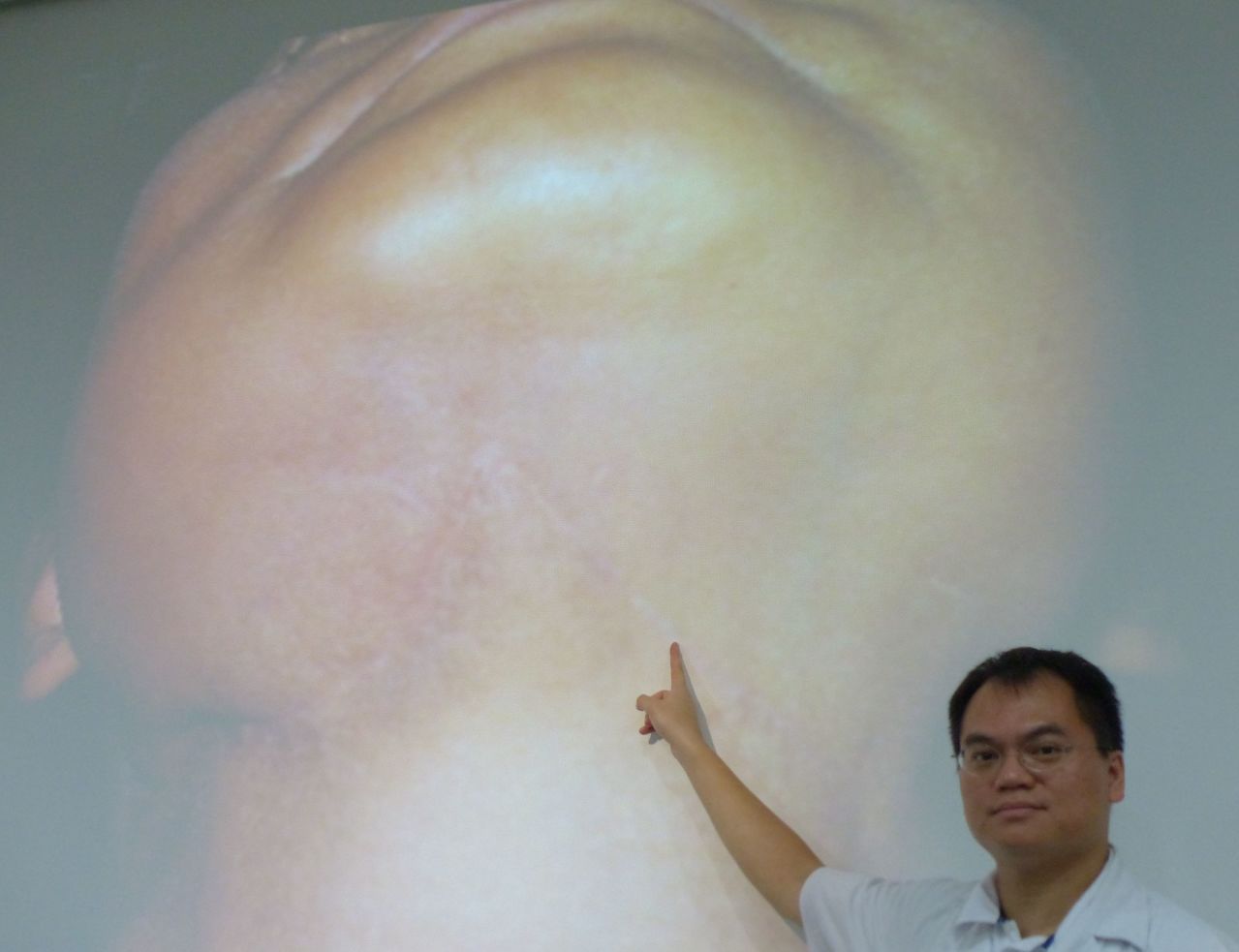 醫師賴志昇說明，陳姓粉領族術後臉部沒有疤痕，維持正常社交生活。記者趙容萱／攝影