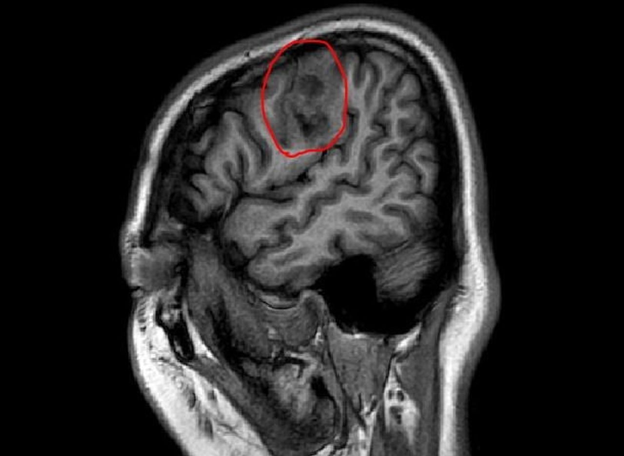 28歲女子右腦頂葉側面靠近中央腦溝附近有一個近3公分大的腫瘤（紅圈處）。圖／醫師韋朝榮提供