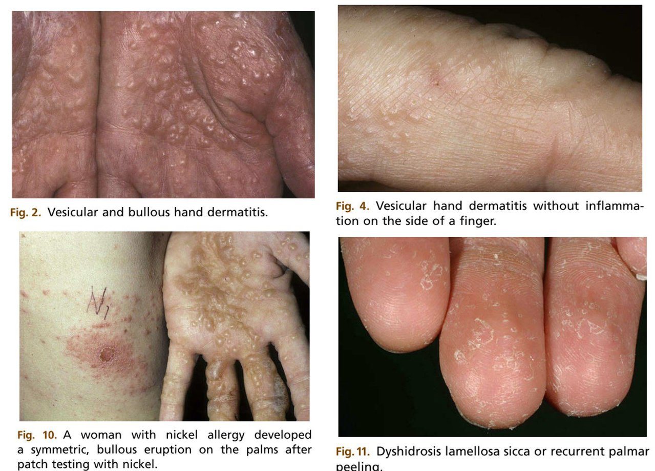 Photo credit: Pompholyx: a review of clinical features, differential diagnosis, and management. Am J Clin Dermatol. 2010;11(5):305.<br>