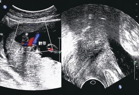 圖為胎兒超音波影像，左為前置胎盤、右為正常。