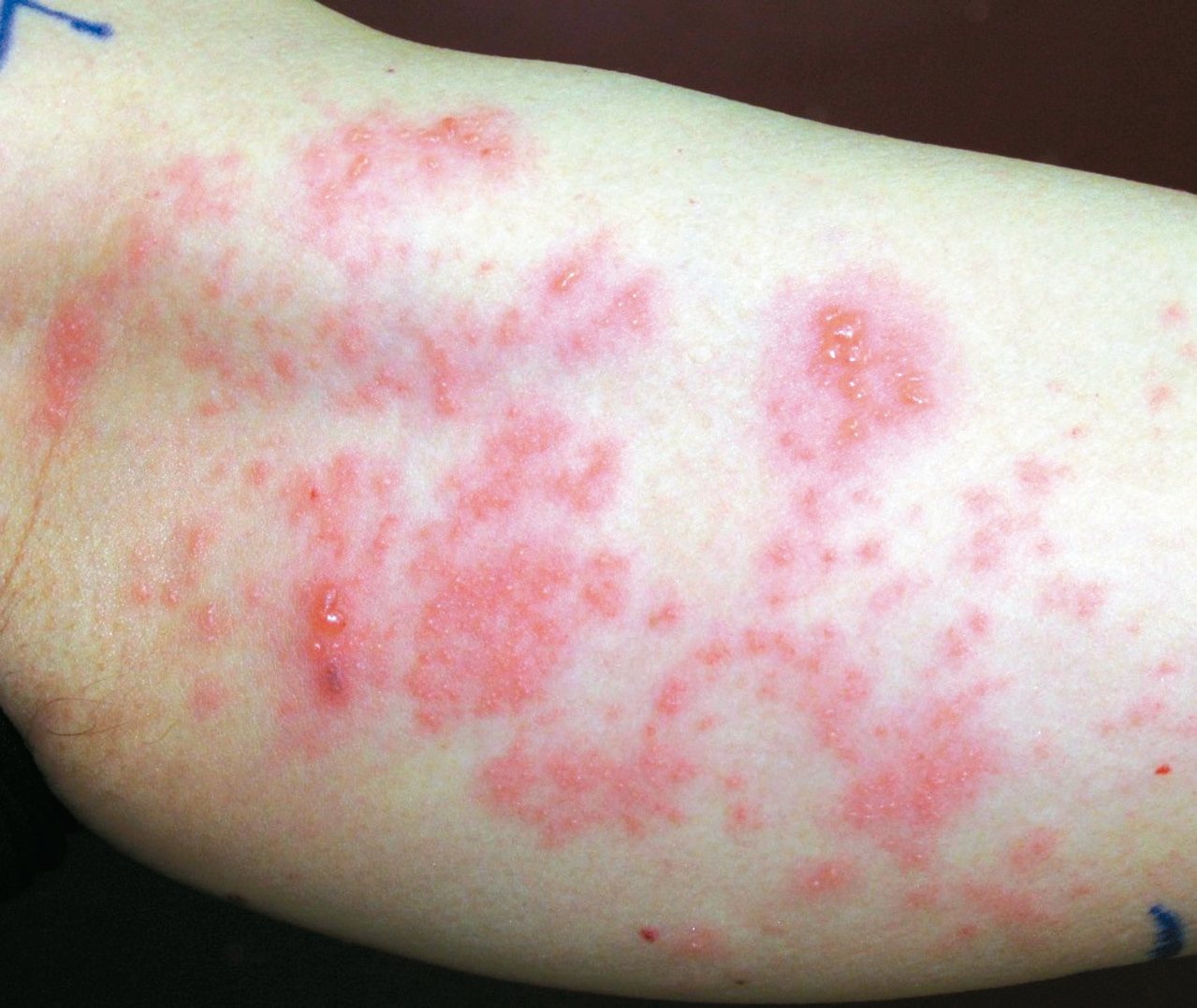 初期帶狀皰疹症狀不明顯，患者常誤以為是其他疾病。<br />報系資料照