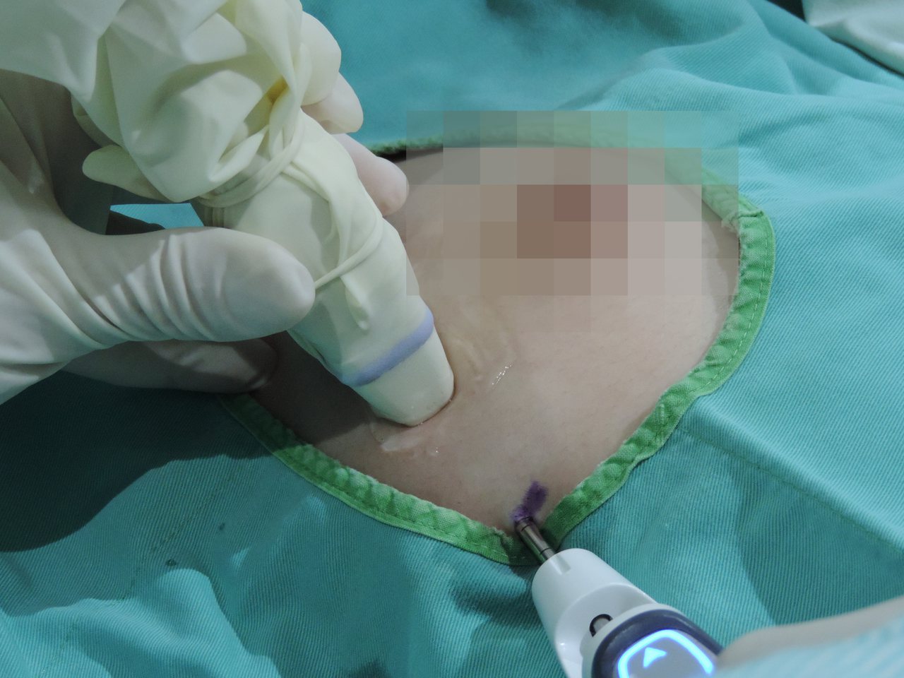台中市長安醫院乳房外科主任黃世民指出，微創手術只會留下0.3至0.5公分的小傷痕。照片／長安醫院提供
