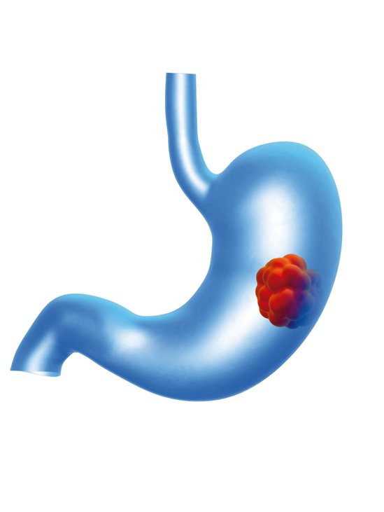 胃潰瘍可能發展成胃癌。